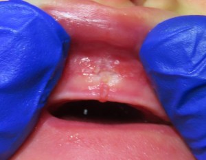 Lip tie after the procedure.