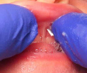 Lip tie before example.