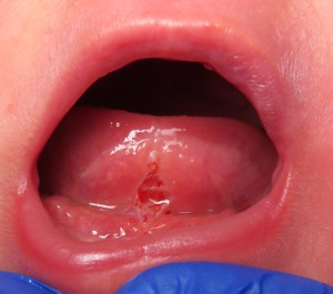 Tongue tie after procedure.