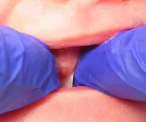 Tongue tie before procedure.