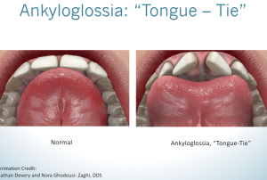 Normal vs. tongue tie exapmle.